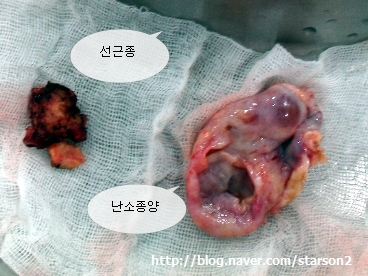 100607rsomyomectomy_starson2.jpg