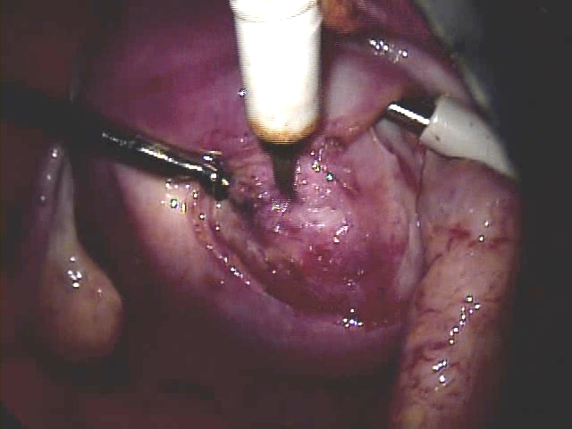 20100510myomectomy5cm000160665.jpg