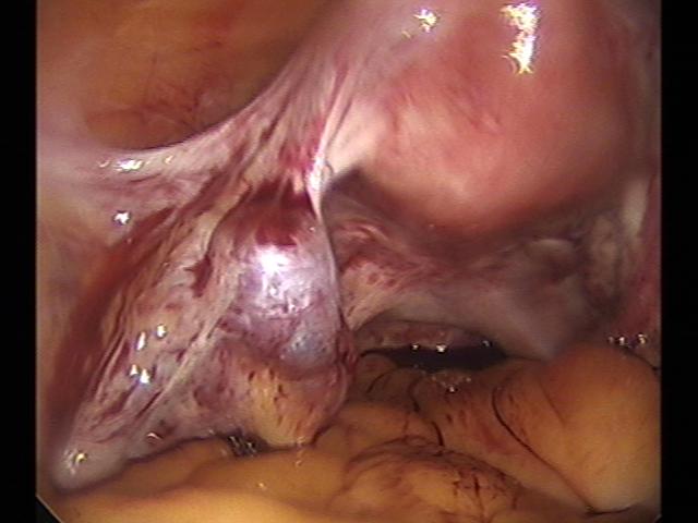 Ectopic (2)(6).jpg