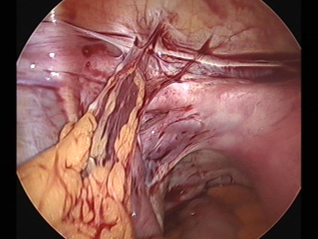 Ectopic (2)(7).jpg