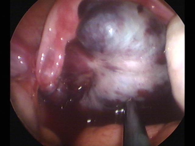 Ovary torsion (3).jpg