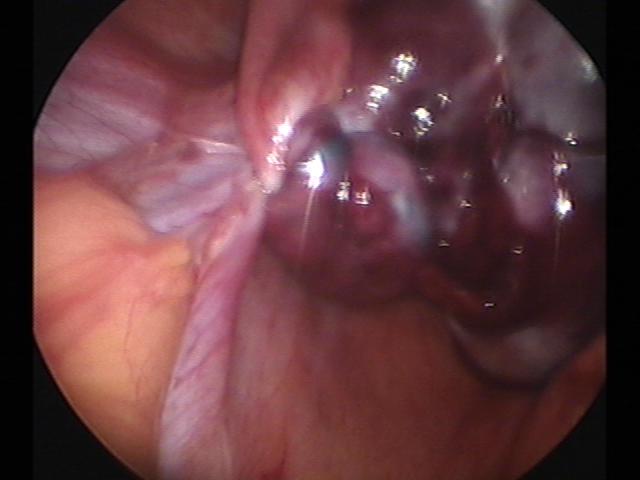 Ovary torsion (4).jpg