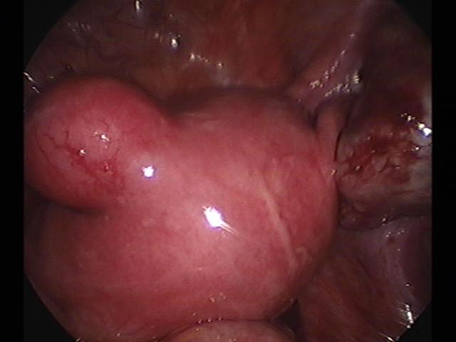 ROC&myomectomy (2)(0).jpg