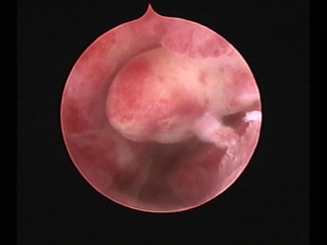 Resectoscopy (2)(43).jpg