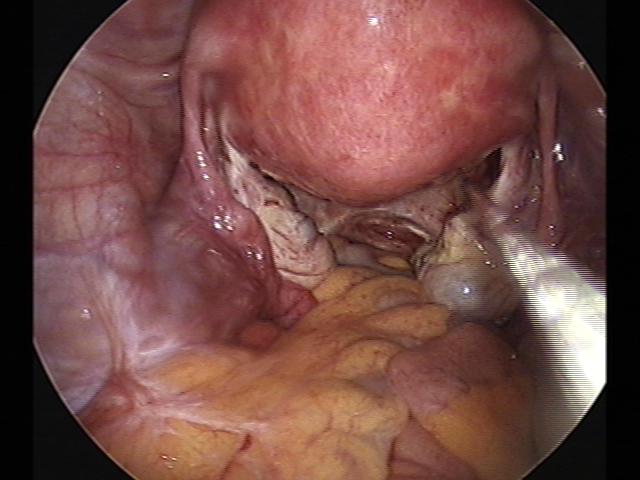 cystectomy (11).jpg
