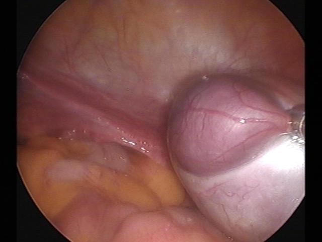 cystectomy (3)(1).jpg