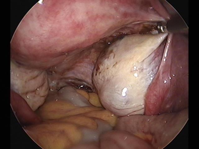 cystectomy (3)(2).jpg