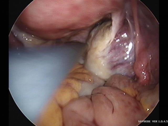 cystectomy(0).jpg