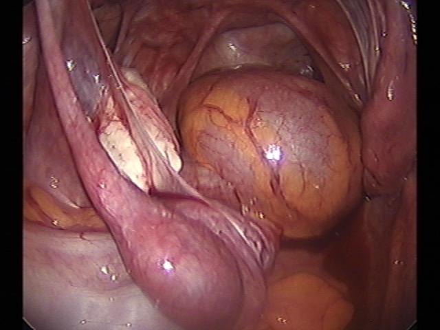 ectopic (3)(4).jpg