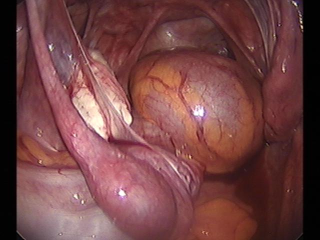 ectopic (3)(4).jpg