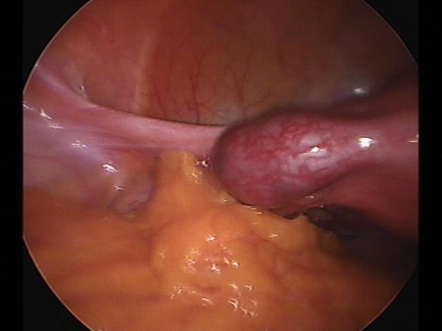 ectopic(7).jpg