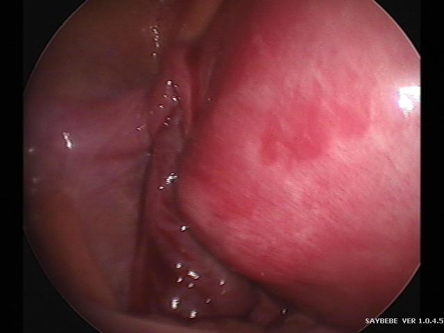 ectopic(8).jpg