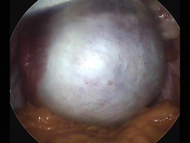 lt cystectomy (2).jpg