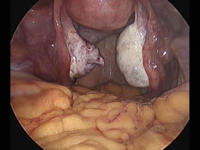 lt cystectomy (3).jpg