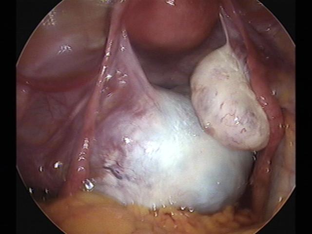 lt cystectomy.jpg