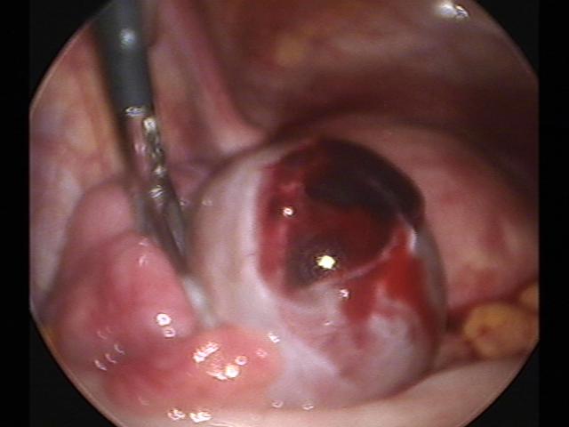 lt ovary cystectomy (2).jpg