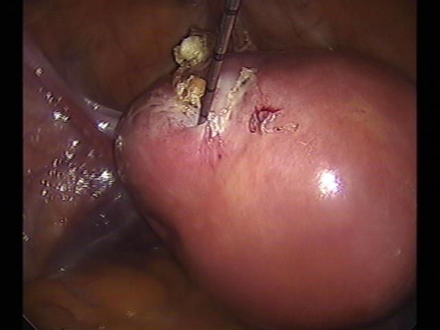 myolysis (7)(0).jpg