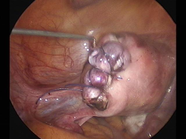 myomectomy (10)(0).jpg