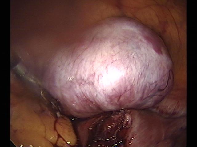 myomectomy (2)(10).jpg