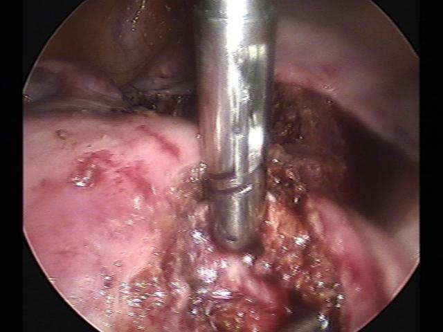 myomectomy (2)(11).jpg