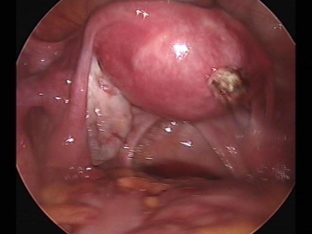 myomectomy (2)(4).jpg