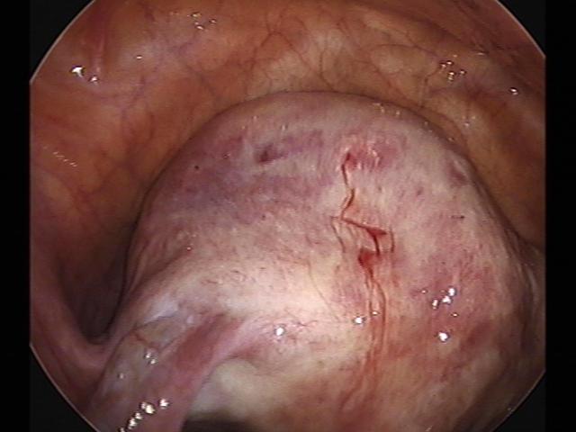 myomectomy (2)(5).jpg