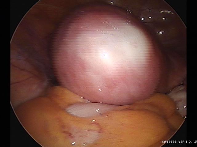 myomectomy (2)(9).jpg