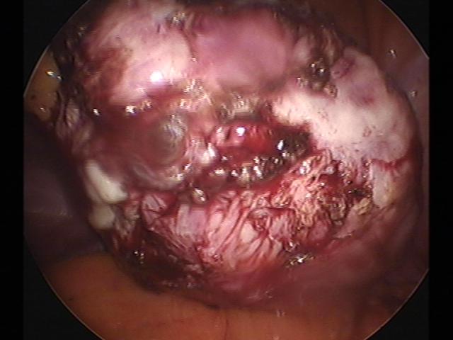 myomectomy (3)(4).jpg