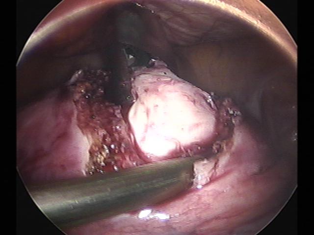 myomectomy (3)(7).jpg