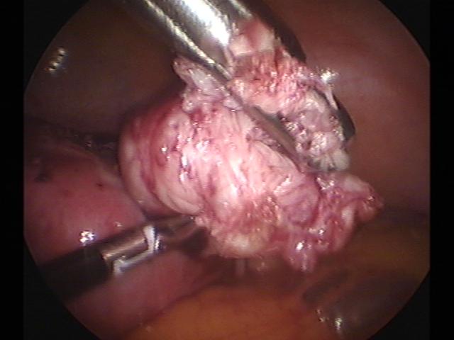 myomectomy (4)(2).jpg