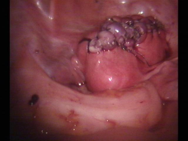 myomectomy (4)(3).jpg