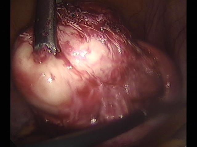 myomectomy (4)(5).jpg