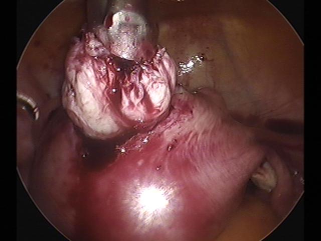 myomectomy (4)(6).jpg