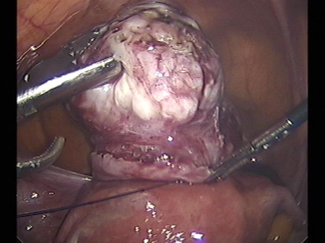 myomectomy (4)(8).jpg