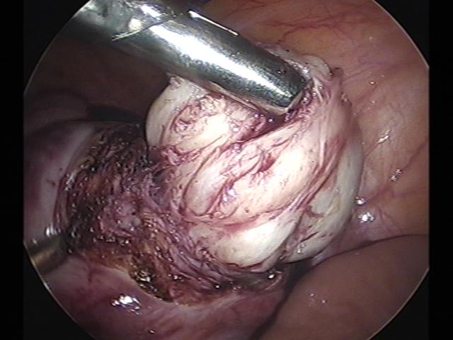 myomectomy (4)(9).jpg