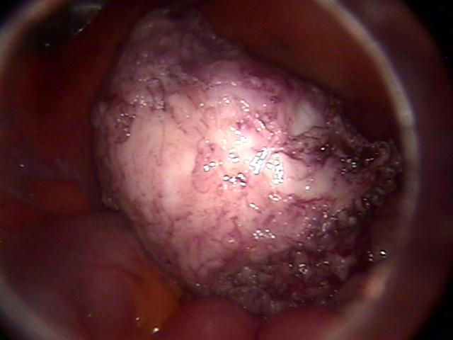 myomectomy (4).jpg