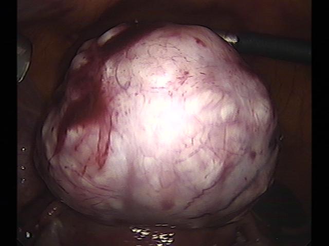 myomectomy (5)(3).jpg