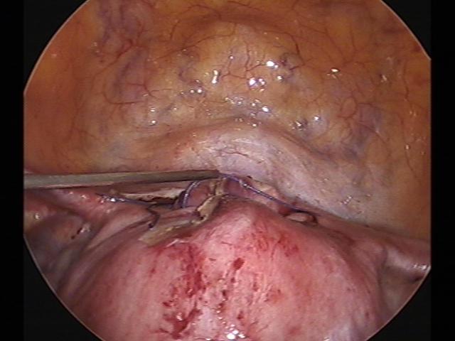 myomectomy (5)(5).jpg