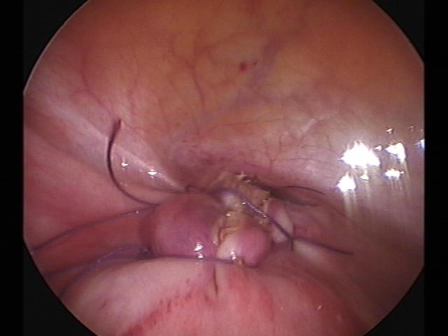 myomectomy (6)(0).jpg