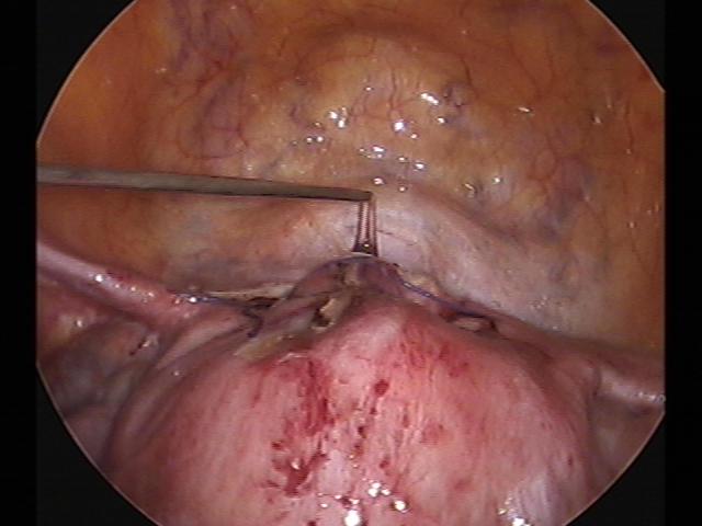 myomectomy (6)(3).jpg