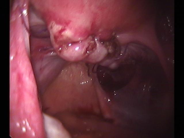 myomectomy (7)(1).jpg
