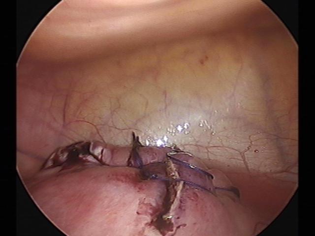 myomectomy (7)(2).jpg