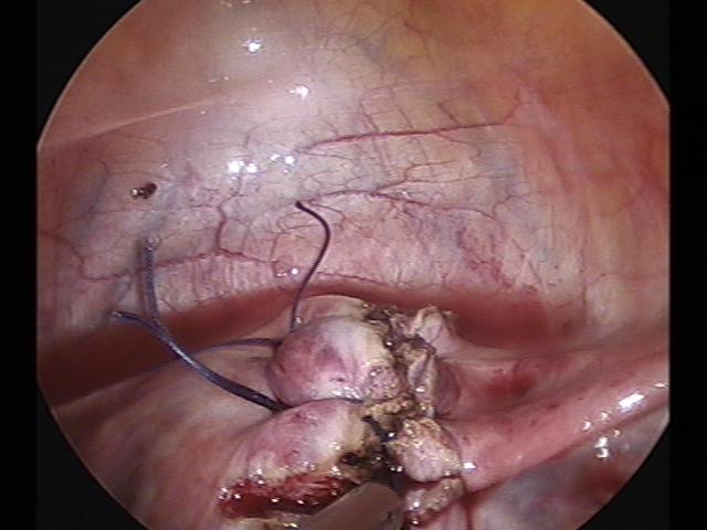 myomectomy (7)(3).jpg