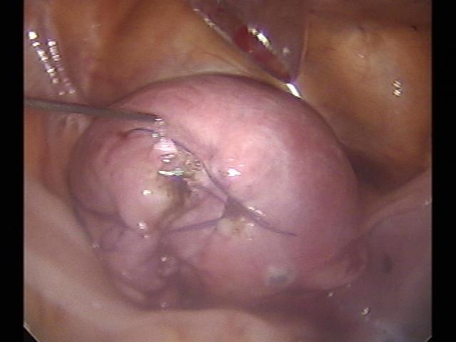 myomectomy (8)(0).jpg