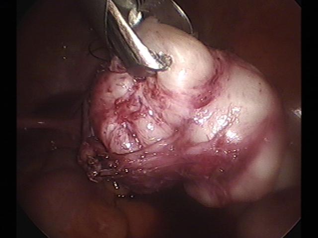 myomectomy (9).jpg