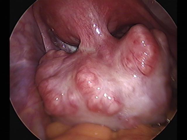 myomectomy(10).jpg