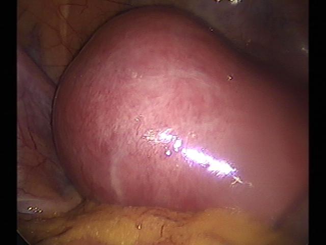 myomectomy(11).jpg