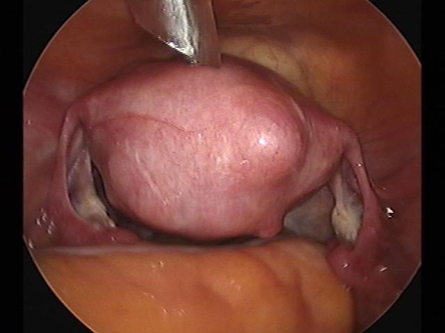 myomectomy(12).jpg