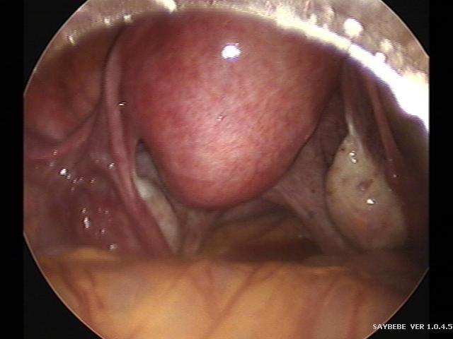 myomectomy(14).jpg