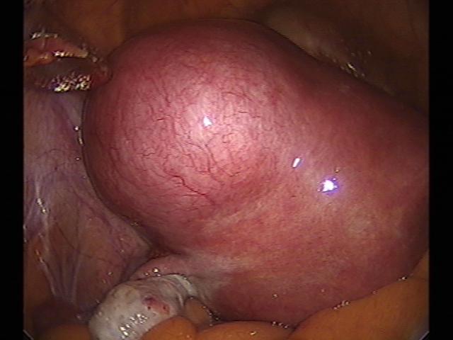 myomectomy(16).jpg